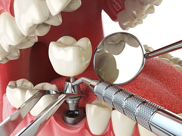 Best Knocked-Out Tooth (Avulsed Tooth) Treatment in USA